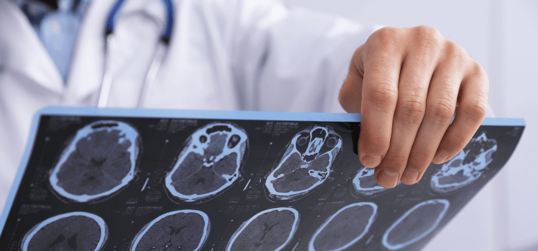 Quantifying Mild TBI The Role of Advanced Post-Processing in Case Valuation